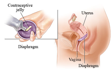 diaphragm barrier contraceptive