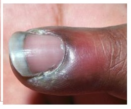 paronychia nail fold infection