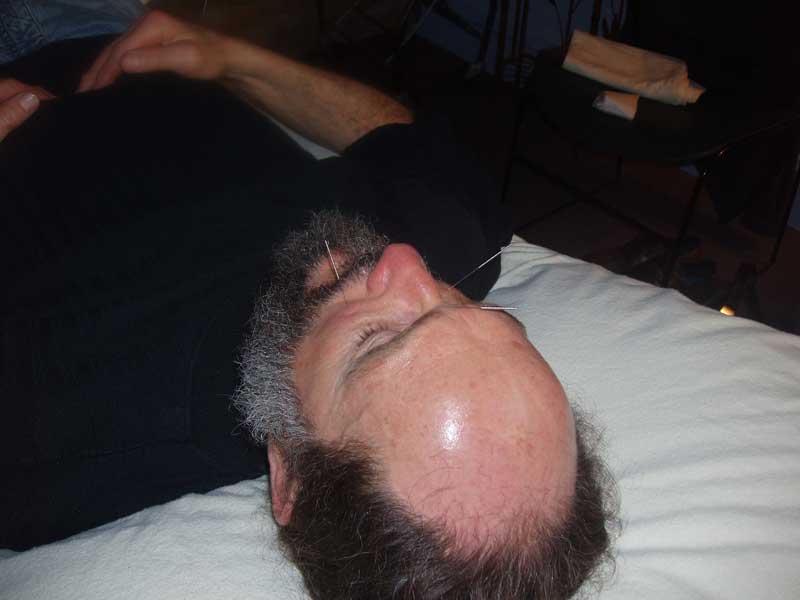 acupuncture therapy 