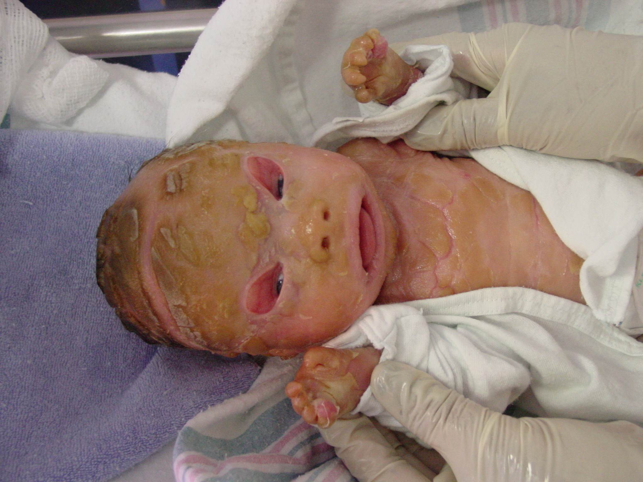 covered with plates of thick skin that crack and split apart. The thick skin plates can pull at and distort the infant's facial features.