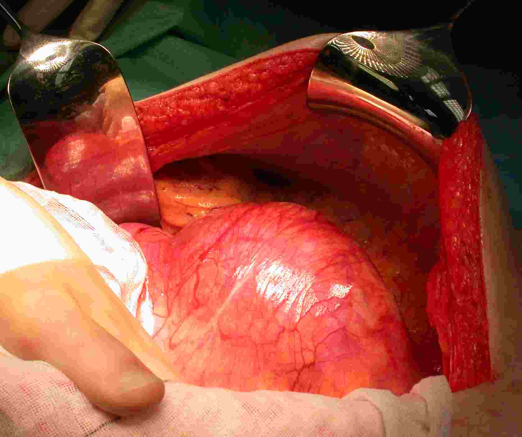 view of thoracic aneurysm during surgical treatment