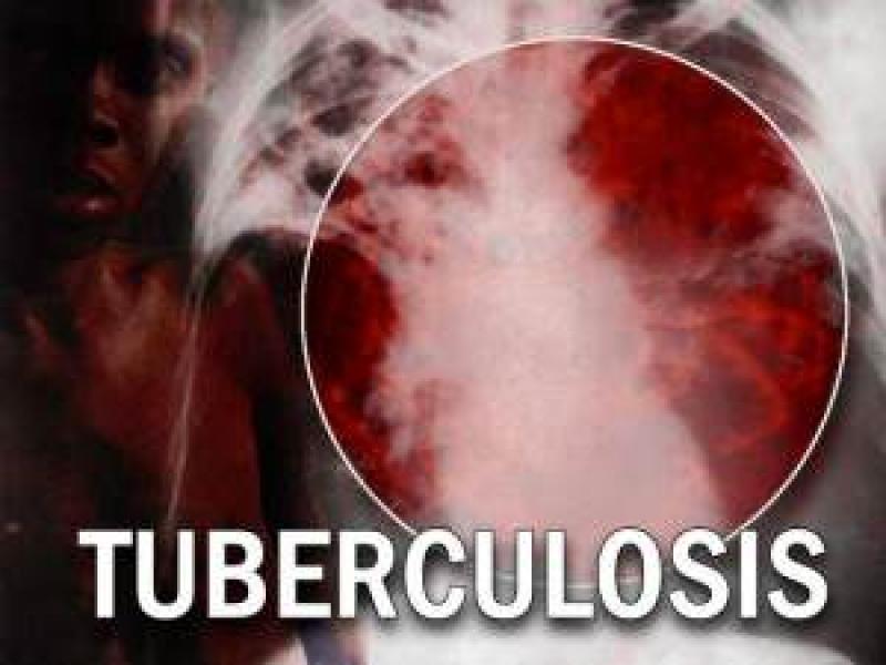 Cases of tuberculosis increasing. Why?
