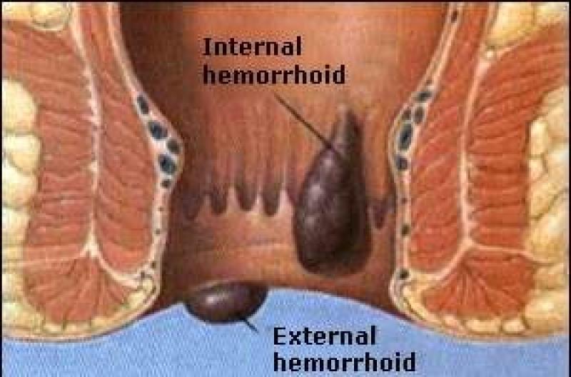 SILENT NO MORE: GET HELP FOR YOUR HEMORRHOIDS/PILES