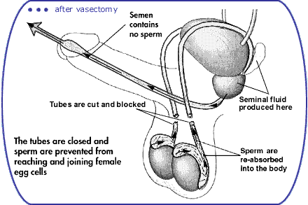 Vasectomy- birth-control-permanent