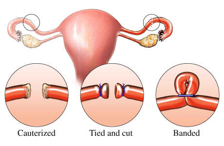 female sterilization-band-cut-ligation-tube