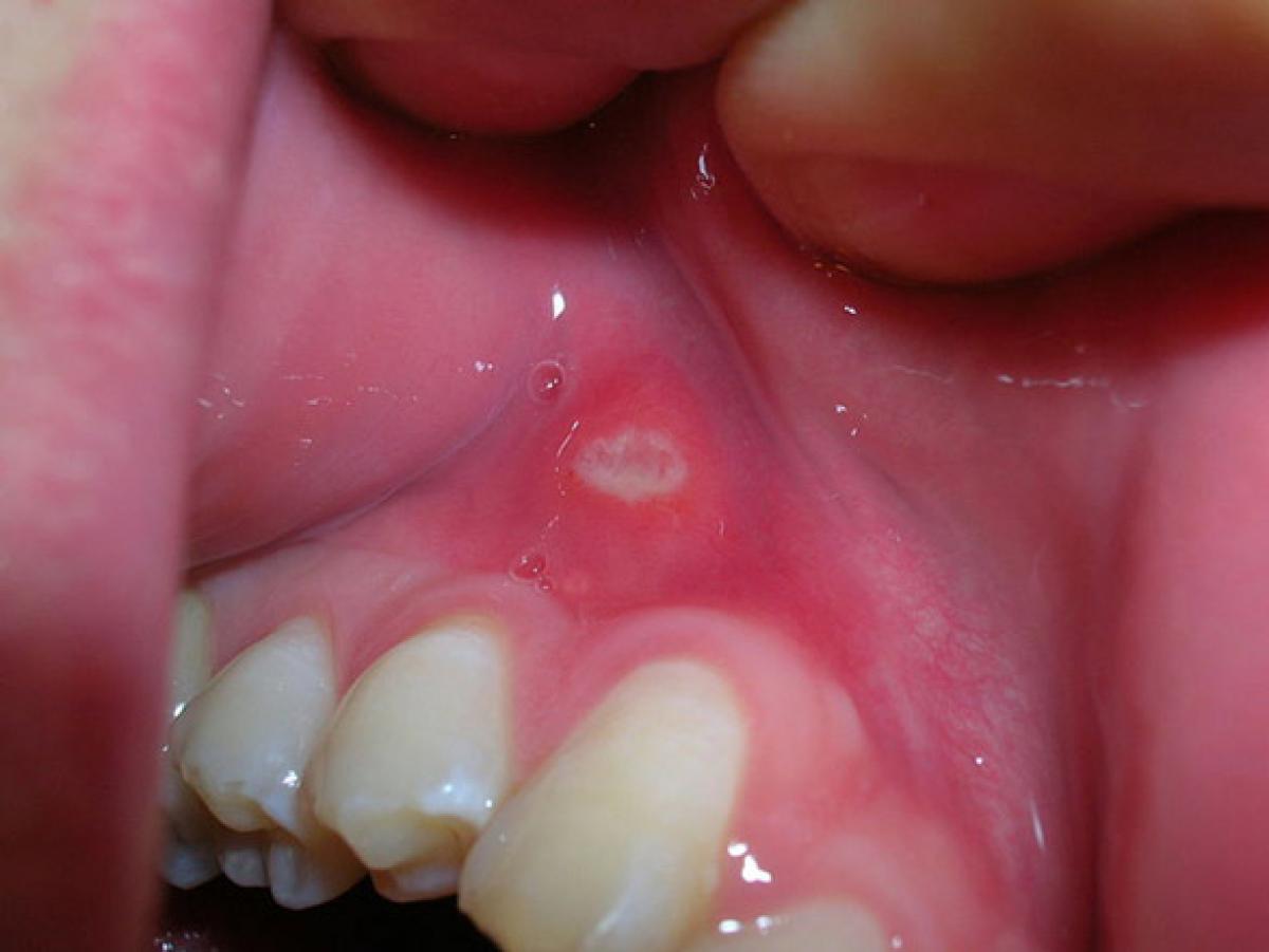 Mouth Ulcers - Canker Sores or Aphthous Stomatitis